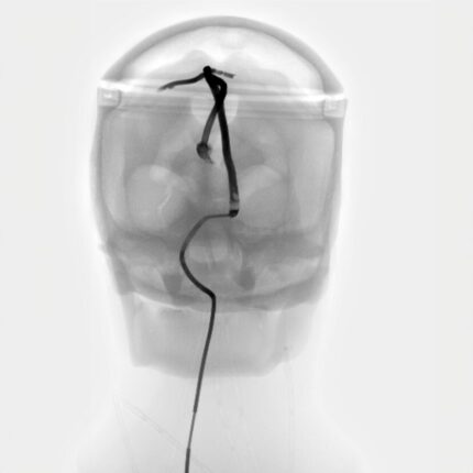Digital Subtraction Angiography of Head phantom from True Phantom Solutions