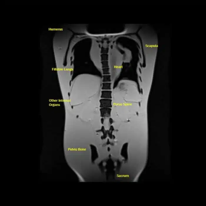MRI T2 Coronal View