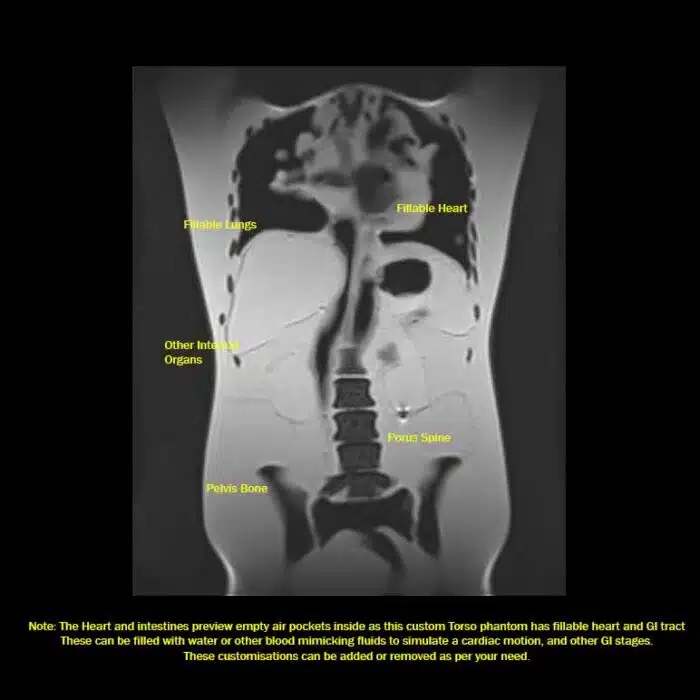 MRI T2 Coronal View